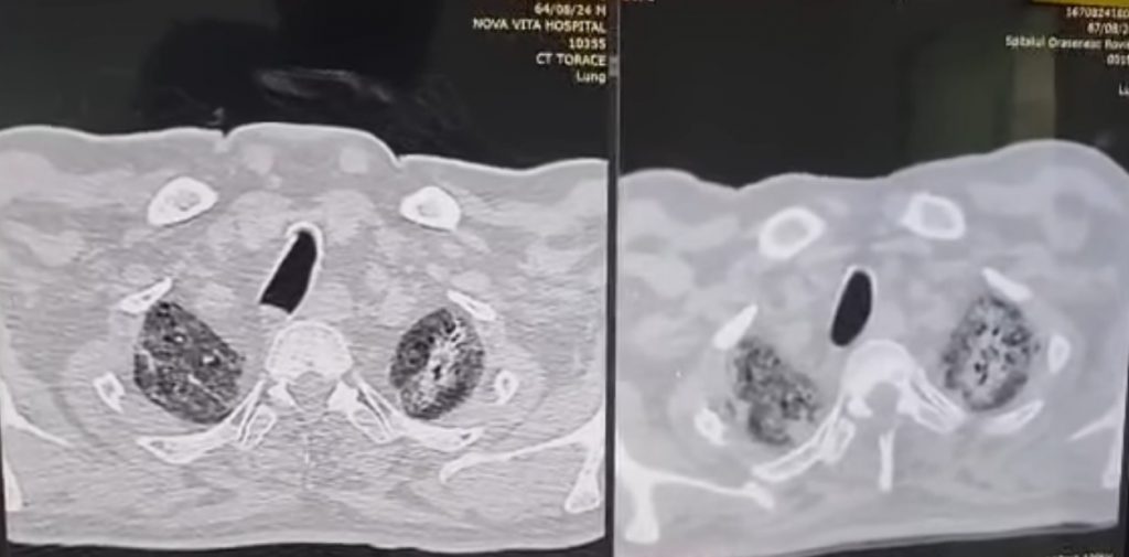 VIDEO Pacient cu afectare pulmonară de 100% transferat de la secția ATI Târgu Jiu la Clinica de Medicină Hiperbară Mureș